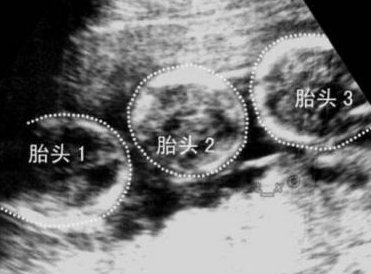 多囊卵巢做哪种运动好？什么样的运动适合多囊卵巢？